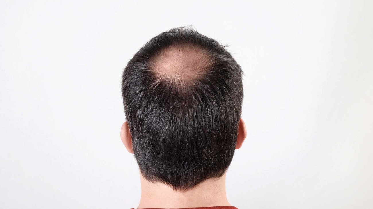 Scientists Have Found a Way to Use Stem Cells to Grow New Hair | Muscle &  Fitness