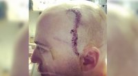 Police Officer John Canter after his surgery for having Moyamoya disease